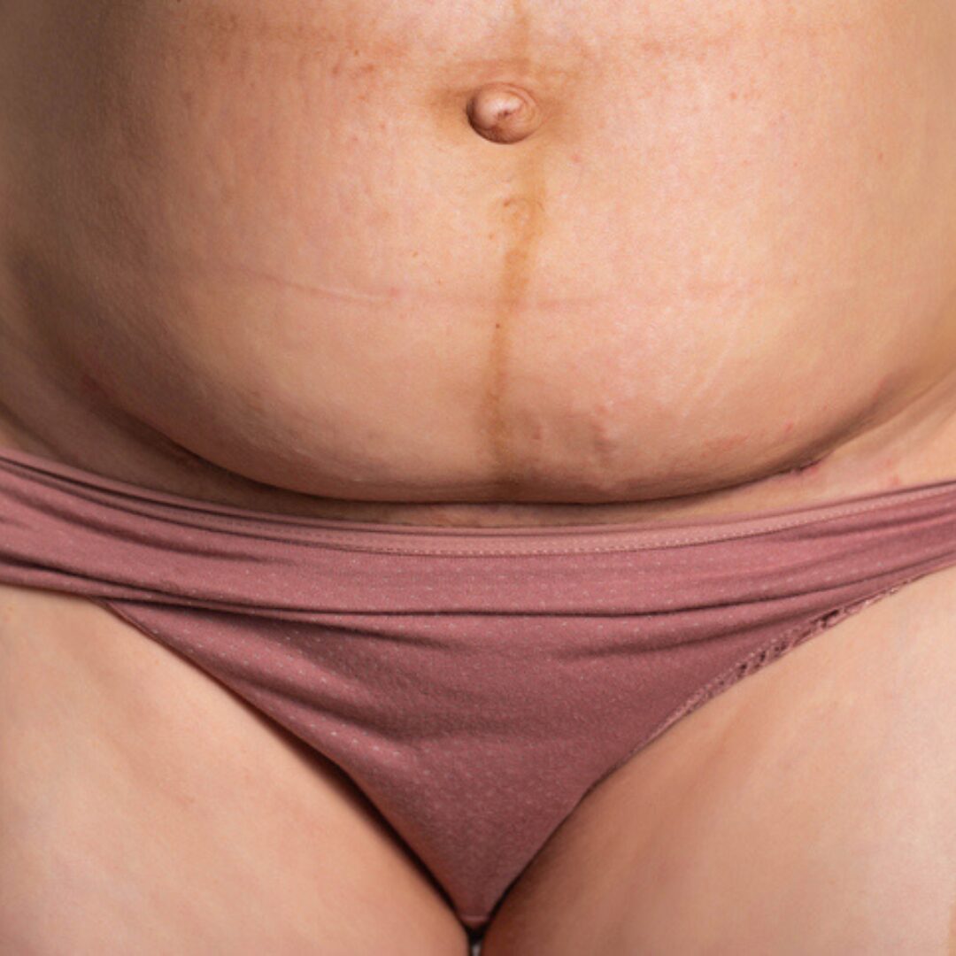 Overhang Free Download C-Section Scar